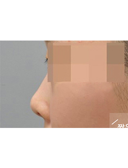 韩国balance整形外科隆鼻手术对比案例
