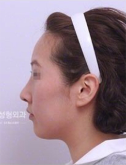 韩国propose整形外科驼峰鼻矫正手术案例
