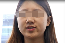 面部吸脂后脸下垂？韩国医院教你一招轻松避免后遗症。
