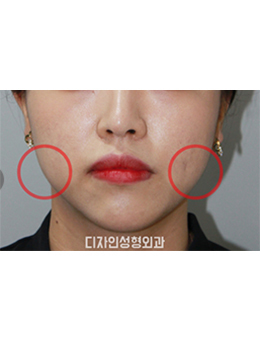 韩国釜山Design整形-韩国釜山design整形医院面部吸脂手术对比案例