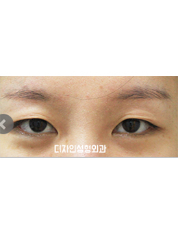 韩国釜山design整形医院眼部手术对比案例_术前