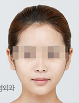韩国本爱整形医院-韩国本爱整形外科轮廓手术案例