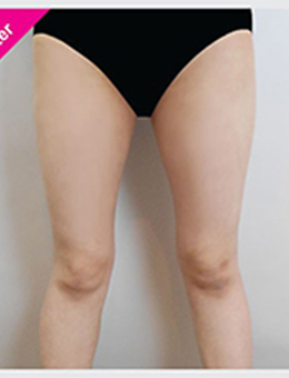 韩国perfect整形外科大腿环吸案例对比