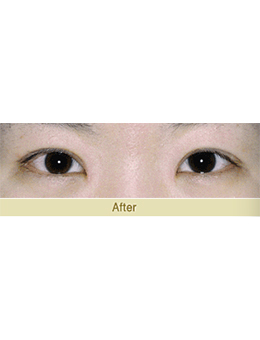 韩国JAESSIA整形外科眼综合手术对比案例_术后