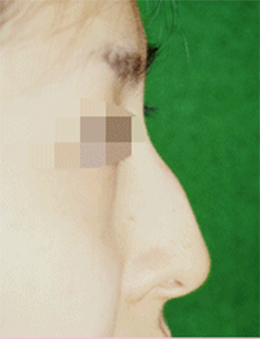 韩国BAO整形外科驼峰鼻矫正手术对比案例