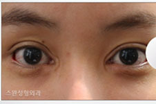眼角括号疤痕怎么去掉？韩国Swan修复失败双眼皮！