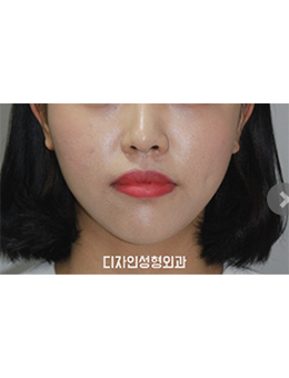 韩国釜山Design整形-韩国釜山design整形医院面部吸脂手术对比案例