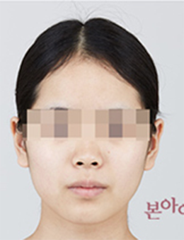 韩国本爱整形医院-韩国本爱整形外科轮廓手术案例