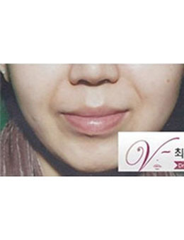 韩国dr.choi注射瘦脸针祛法令纹案例对比