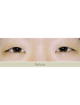 韩国JAESSIA整形外科眼综合手术对比案例