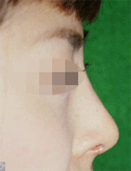 韩国BAO整形外科驼峰鼻矫正手术对比案例_术后