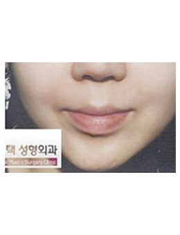韩国dr.choi注射瘦脸祛法令纹日记对比