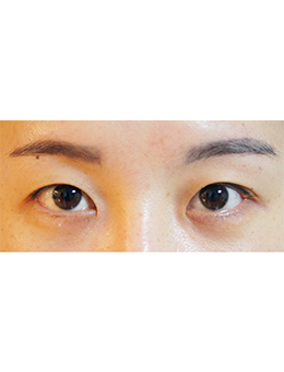 韩国jstar整形外科眼部手术对比案例_术前