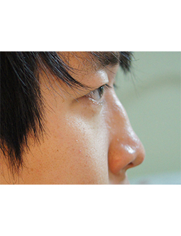 韩国jstar整形外科驼峰鼻矫正手术对比日记