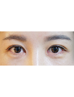 韩国jstar整形外科眼部手术对比案例
