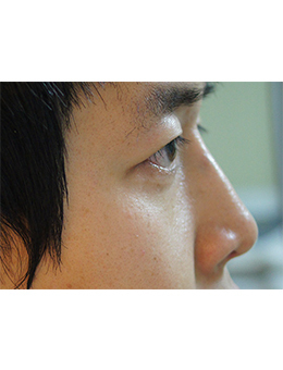 韩国jstar整形外科驼峰鼻矫正手术对比案例