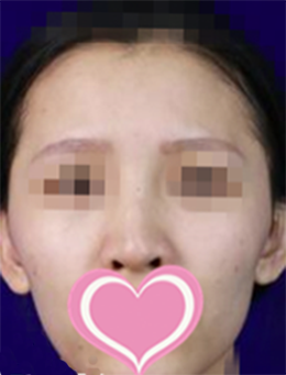 韩国世民整形外科面部脂肪填充手术对比案例