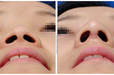 韩国医院鼻翼缩小手术多少钱？多组案例说明手术细节特点