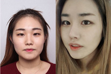 韩国本爱整形做眼睛怎么样？案例图合辑看你是否喜欢！