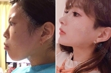 凸嘴和双鄂手术区别有哪些，韩国医院如何矫正？