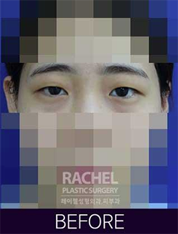 韩国Rachel整形医院-韩国蕾切尔整形外科双眼皮手术对比日记