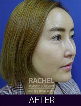韩国蕾切尔整形外科面部脂肪填充手术对比案例_术后