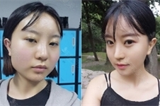 韩国GNG做轮廓眼鼻手术怎么样，医院真人案例效果如何？