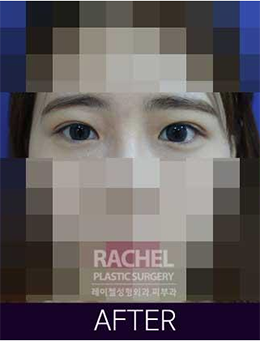 韩国蕾切尔整形外科双眼皮手术对比案例_术后