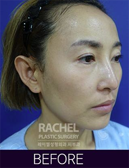 韩国蕾切尔整形外科面部脂肪填充手术对比案例_术前
