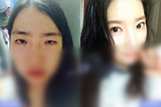 哪里做韩式双眼皮效果好？灰姑娘、BIO榜上有名！