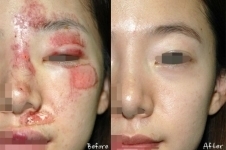 韩国dr.ham医生疤痕诊疗怎么样？术后效果真的好吗？