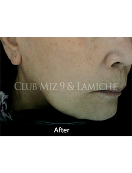 韩国lamiche皮肤科埋线提升手术对比案例_术后