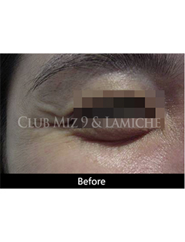 韩国lamiche皮肤科瘦脸针祛皱手术对比案例_术前