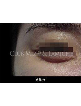 韩国lamiche皮肤科瘦脸针祛皱手术对比案例