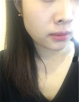 韩国林二石瘦脸针瘦脸针效果反馈案例