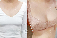 韩国JW和棒棒做娜绮丽胸部整形价格差多少，选谁合适？