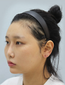 韩国脸本脸骨整形外科颧骨整形案例