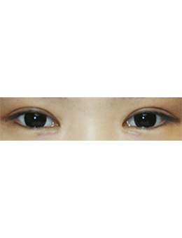 韩国shims整形外科双眼皮手术对比日记