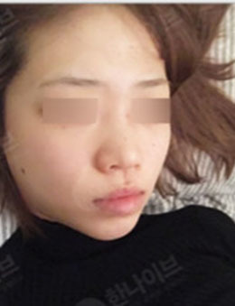 韩国韩拿eve整形外科鼻综合案例对比效果_术前