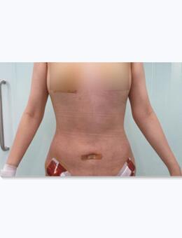 韩国babiline医院腹部吸脂对比图