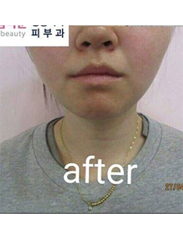 韩国thebuty整形外科面部吸脂手术对比案例