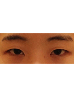 韩国普拉美斯整形医院眼部综合整形案例对比