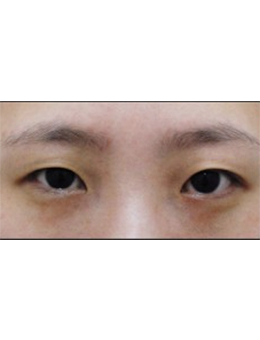 韩国Mina整形外科双眼皮手术对比案例