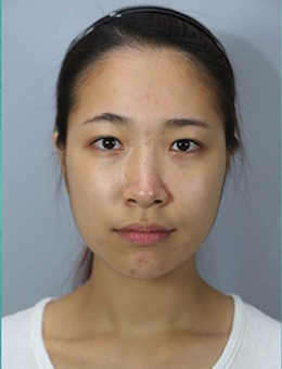 韩国乐希lush整形外科眼鼻综合案例真人对比