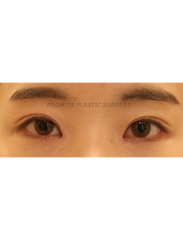 韩国普拉美斯整形医院眼部综合整形案例对比