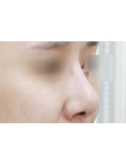 韩国Mina整形外科驼峰鼻矫正手术对比案例