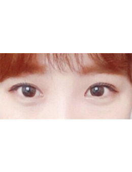 韩国Mina整形外科双眼皮手术对比日记
