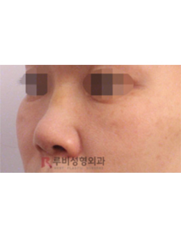 韩国RUBY-韩国如妃整形外科隆鼻修复手术对比日记