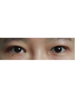 韩国李政自然美整形外科眼综合手术对比案例