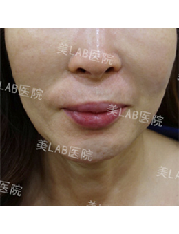 韩国美lab皮肤科面部埋线提升手术案例
